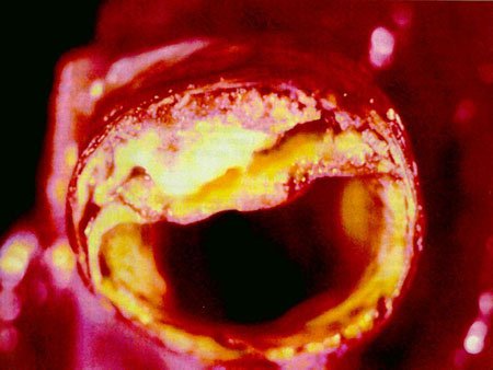 atherothrombose