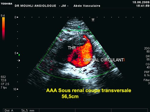 Coupe transversale d'un anevrisme sous renal 