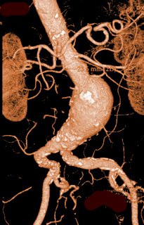 Anevrisme sous renal fusiforme