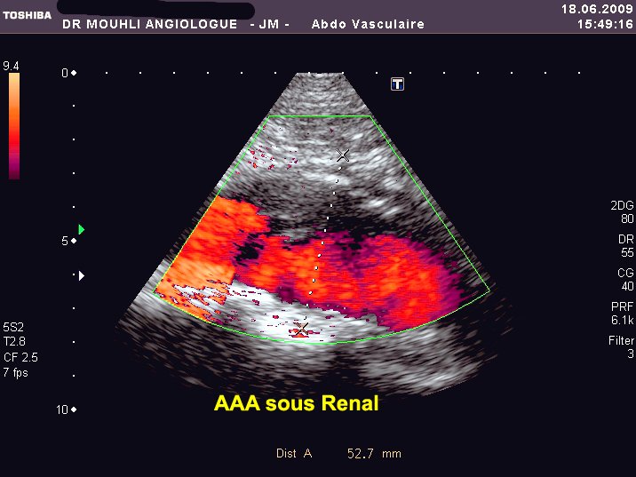 AAAsous renal