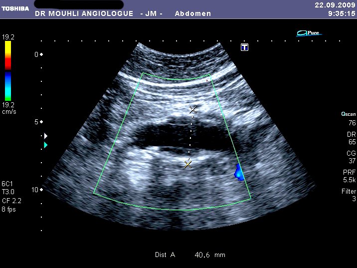 AAA sous renal