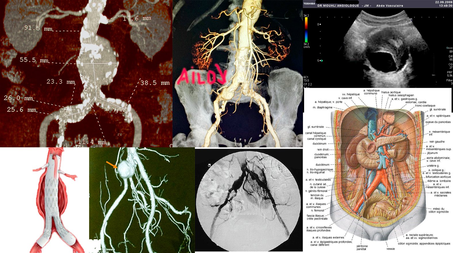 anévrisme est une dilatation de la paroi d'une artère, formant le plus souvent une poche reliée au reste de l'artère.