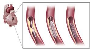 angioplastie coronaire et pose d'un stent