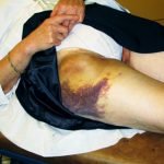 faux anevrisme aprés ponction