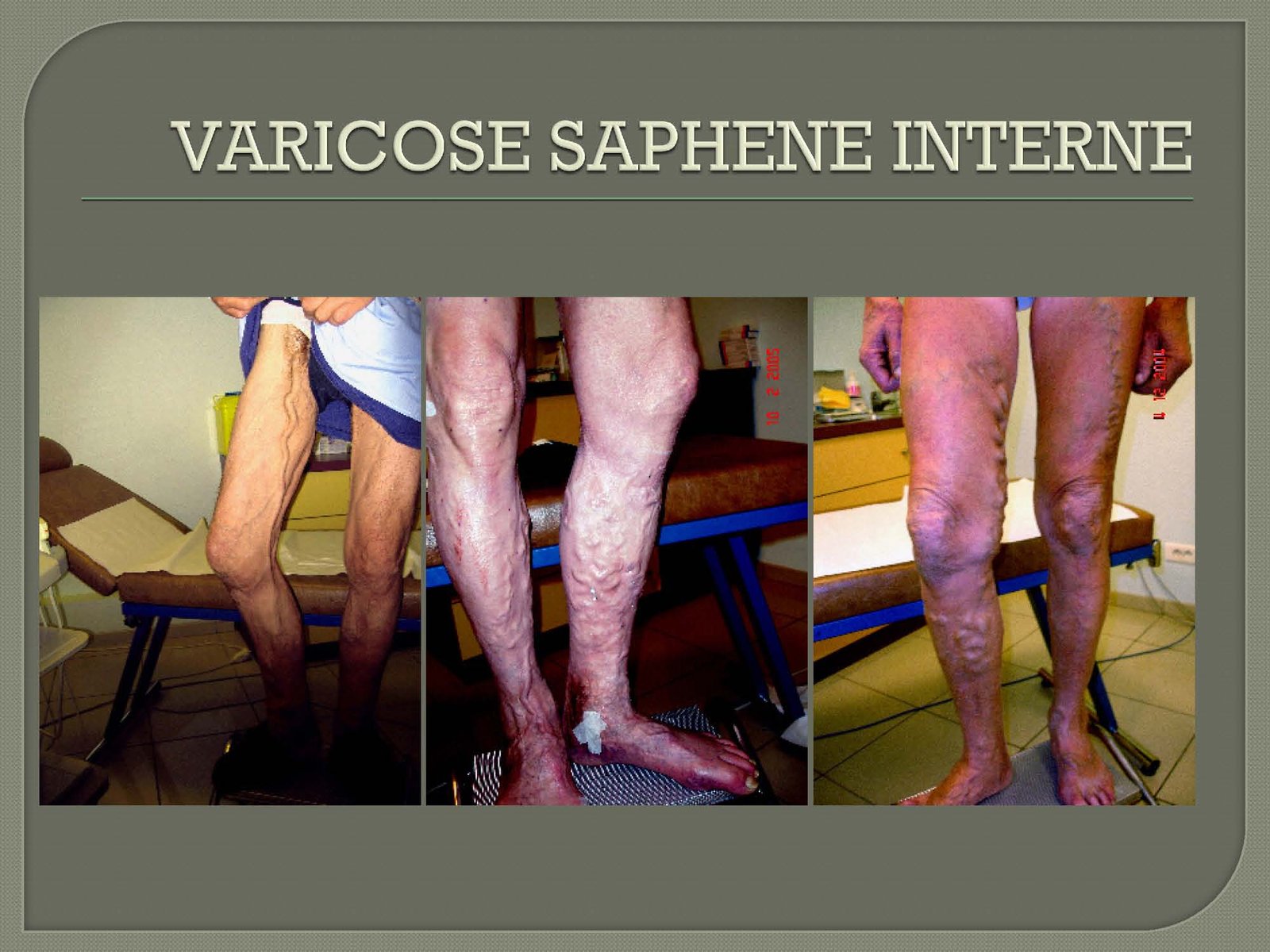 VARICOSE