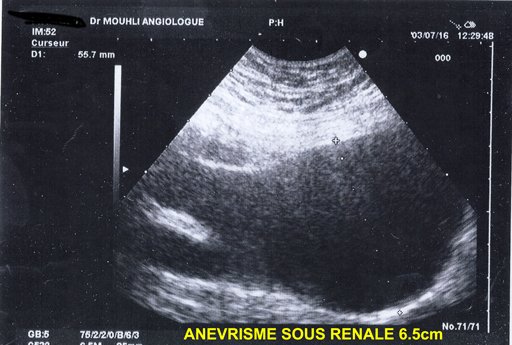 anevrisme sous renal 65mm