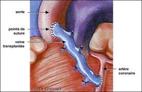 Pont veineux coronaire