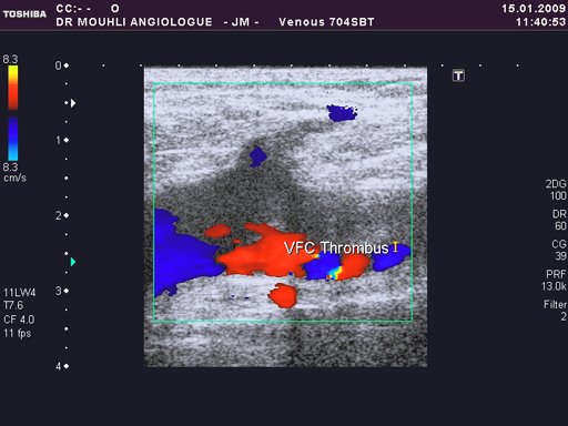 thrombose femorale