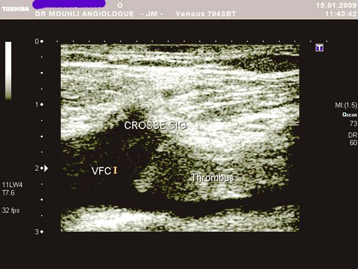 thrombose femoro poplite