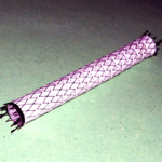 Un stent couvert de 8 mm utilisé pour les lésions iliaques.