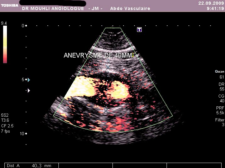 Anevrisme avec thrombus parietal