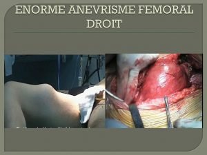 Anevrisme femoral droit