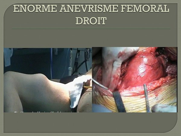 Anevrisme femoral droit 