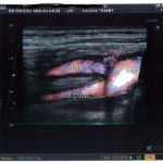 stenting carotide interne droite