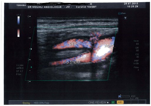 stenting carotide interne droite