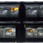 stenting carotide interne droite et plaque anfractueuse et stenosante sur la Carotide primitive droite non visualisé par l&rsquo;angioscanner et l&rsquo;angiographie