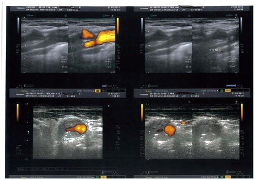 stenting carotide interne droite et plaque anfractueuse et stenosante sur la Carotide primitive droite non visualisé par l'angioscanner et l'angiographie