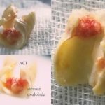 controverse stenting carotidien vis a vis endarteriectomie