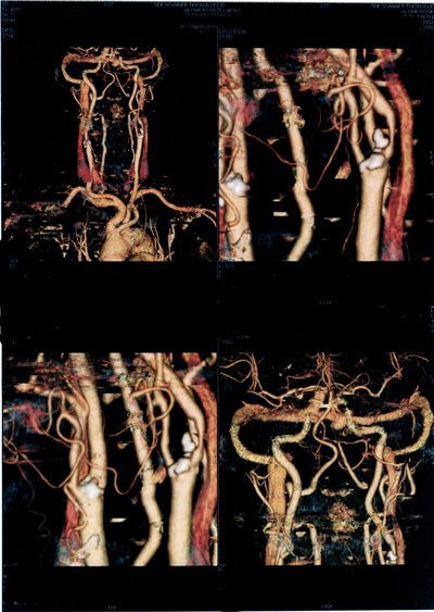 stenose carotidienne bilatérale