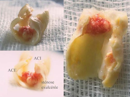 controverse stenting carotidien vis a vis endarteriectomie