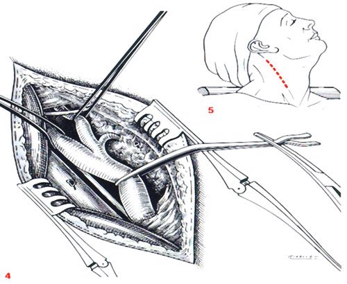 endarteriectomie