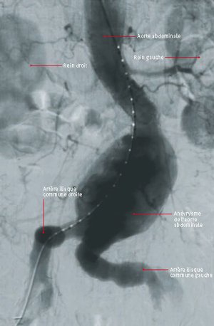 Endoprthése de Lanévrisme de l'aorte