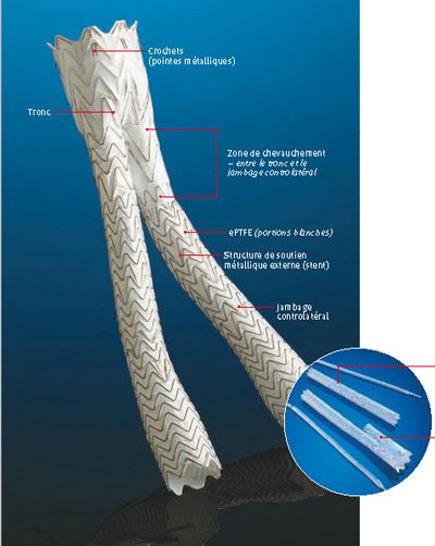 Endoprothése de l'anévrisme de l'aorte abdominale 