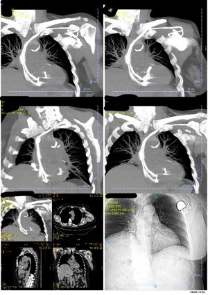 TDM Hélicoïdal Thoraco-brachial