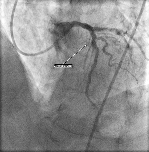 résultat après angioplastie coronaire