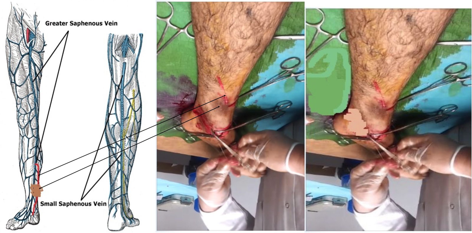 Varicose Vein treatment phlebectomy Ablation