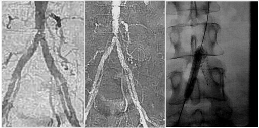 STENOSE SERRE SUR L'AORTE TERMINALE SE PROLONGEANT SUR LES ILIAQUES PRIMITIVES DROITE ET GAUCHE