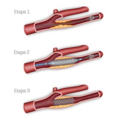 Angioplastie stent carotidien