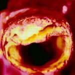 plaque d&rsquo;atherome