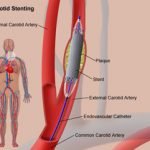 angioplastie stenting carotidien