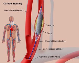 angioplastie stenting carotidien