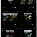triple stenting carotidien