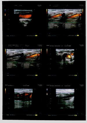 triple stenting carotidien 