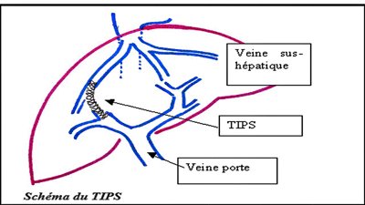 Dérivation porto-cave par voie transjugulaire