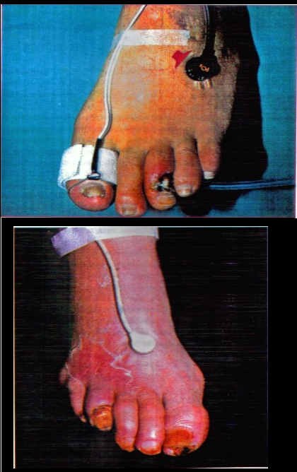  débitmétrie laser-Doppler dans l'exploration microcirculatoire des artériopathies des membres à côté de la mesure transcutanée de la pression d'oxygène (TcpO2)