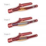 angioplastie-carotidienne