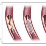 angioplastiecoronaire
