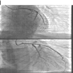 coronarographie-1_page_11