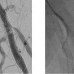 endovascular-therapy-for-restenosis-of-a-stent-placed-over-the-femoral-bifurcation