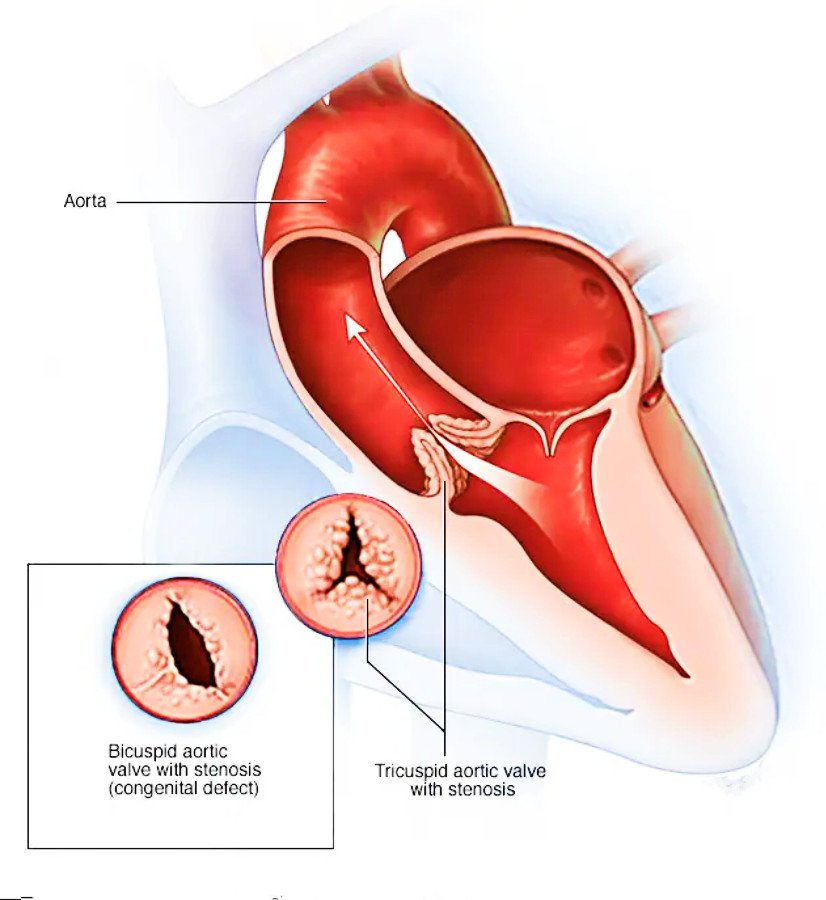 Remplacement valvulaire aortique par voie transcathéter (TAVR) Vous pourriez avoir besoin d'une chirurgie de la valve aortique si votre valvulopathie affecte la capacité de votre cœur à pomper le sang. Si vous ne présentez pas de symptômes ou si votre affection est légère, votre équipe soignante pourrait vous suggérer des bilans de santé réguliers, des changements de mode de vie et un traitement médicamenteux. Cependant, la plupart des affections de la valve aortique nécessitent une intervention chirurgicale pour atténuer les symptômes et diminuer le risque de complications telles que l'insuffisance cardiaque. La décision de réparer ou de remplacer une valve aortique endommagée dépend de nombreux facteurs, notamment :