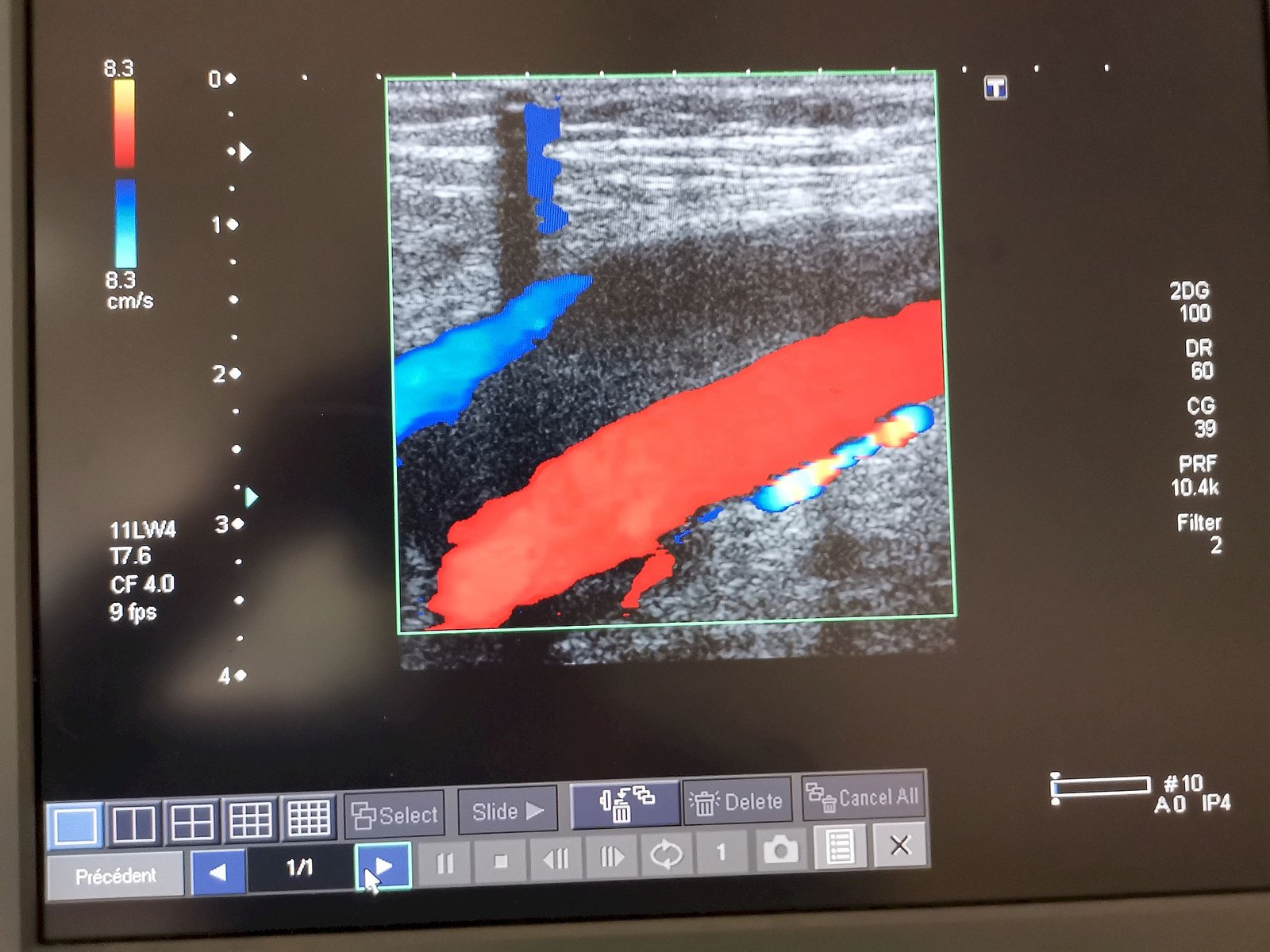  COVID 19h homme 57ans thrombophlébite poplité 