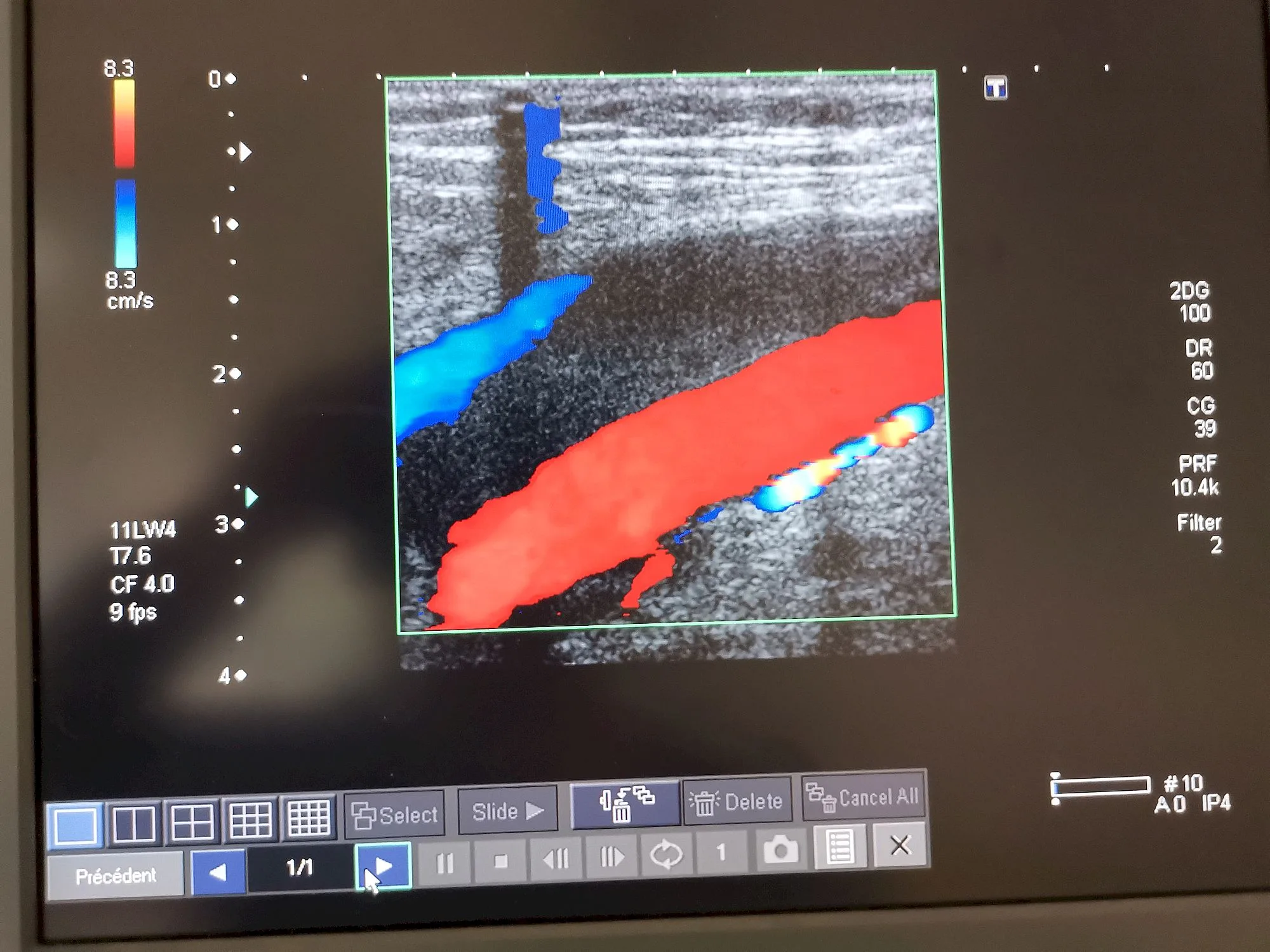 COVID 19h homme 57ans thrombophlébite poplité 