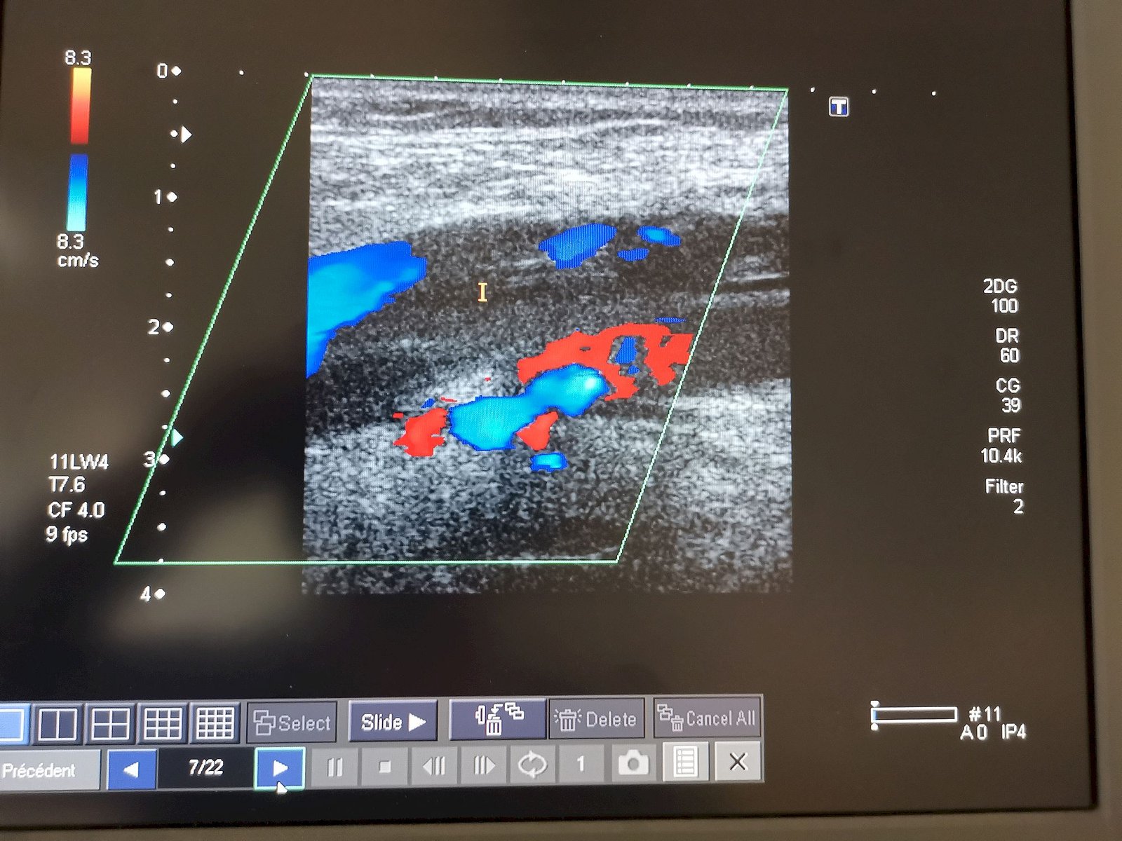  COVID 19h homme 57ans thrombophlébite poplité 