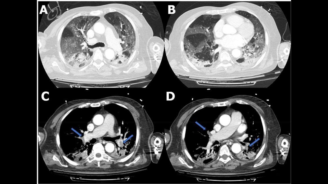 Published today in  @radiology_rsna : Pulmonary, Cerebral, and Renal Thromboembolic Disease Associated with COVID-19 Infection. https://bit.ly/3bA4eYG #COVID19