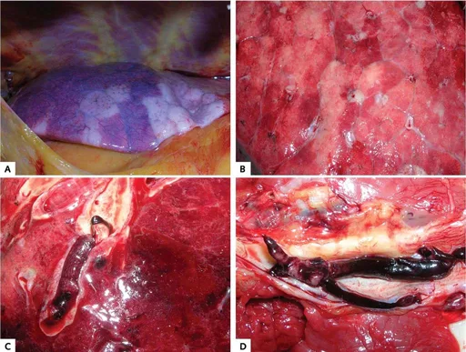 Figure 2. Résultats de l'autopsie macroscopique. A. Aspect irrégulier de la surface pulmonaire (cas 1). B. Surface de coupe du poumon dans le cas 4. C. Embolie pulmonaire (cas 3). D. Thrombose veineuse profonde (cas 5). Figure 2. Résultats de l'autopsie macroscopique. A. Aspect irrégulier de la surface pulmonaire (cas 1). B. Surface de coupe du poumon dans le cas 4. C. Embolie pulmonaire (cas 3). D. Thrombose veineuse profonde (cas 5).