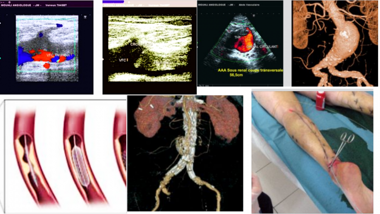 Les médecins vasculaires (angiologues), les chirurgiens vasculaires et cardiovasculaires, les neurologues, les radiologues interventionnels, les cardiologues interventionnels, les néphrologues, les endocrinologues, les hématologues prennent en charge le diagnostic et le traitement de l’ensemble des pathologies des vaisseaux sanguins (artères, veines, lymphatiques). Les patients sont orientés par leurs médecins généralistes.